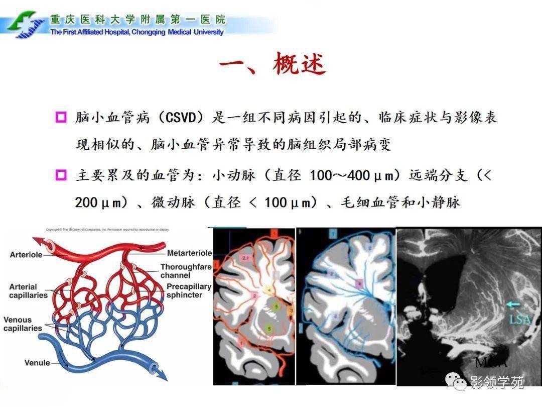 動脈壁脂肪玻璃樣變,玻璃樣變,纖維素樣壞死,微粥瘤,微小動脈瘤散發或