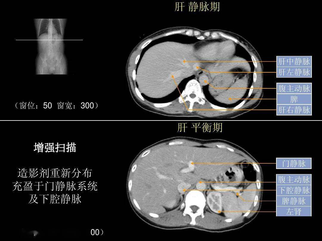 肝脏ct解剖图谱图片