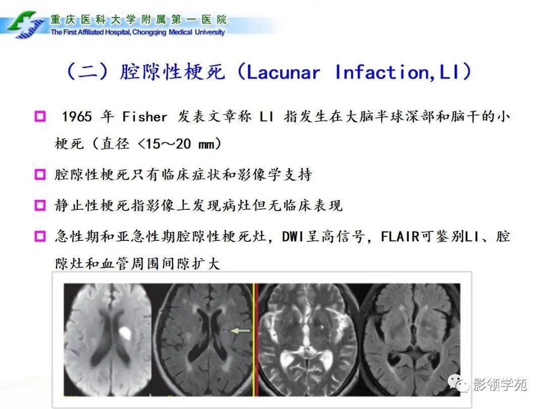 脑小血管病的影像学诊断