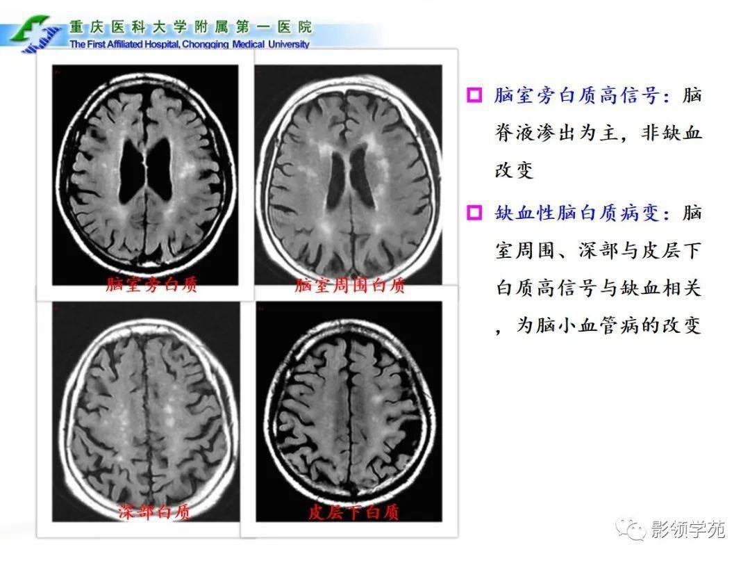 脑小血管病的影像学诊断