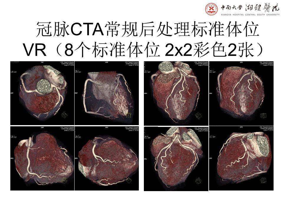 湘雅医院冠脉CTA标准化图像后处理及规范化诊断报告书写-搜狐大视野-搜狐新闻