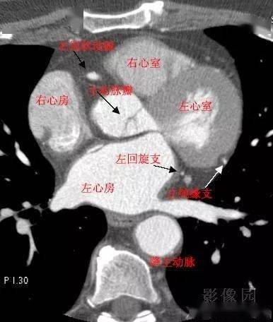 影像解剖 心脏冠状动脉ct解剖中文详细标注(图文)