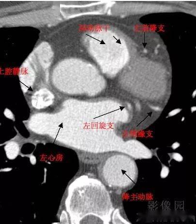 心脏CT横断面解剖图图片