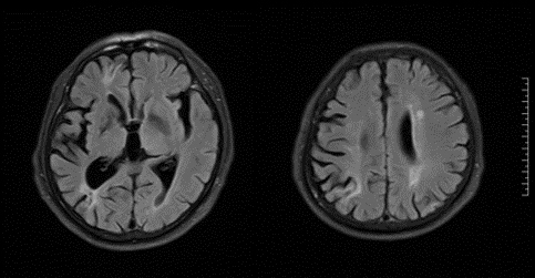 双侧基底节区,右侧丘脑,桥脑,右侧小脑半球多发陈旧性脑梗塞伴软化灶