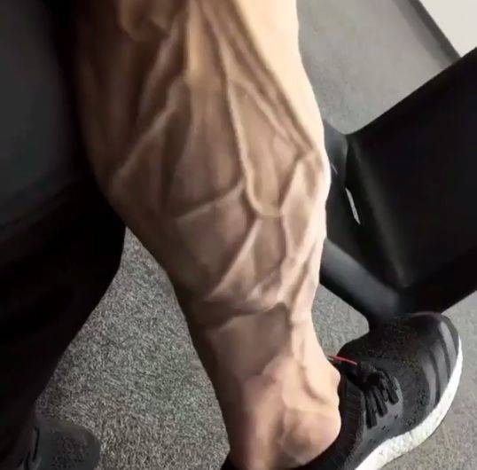 26岁健美冠军小腿静脉爆裂又一起低体脂引发的悲剧