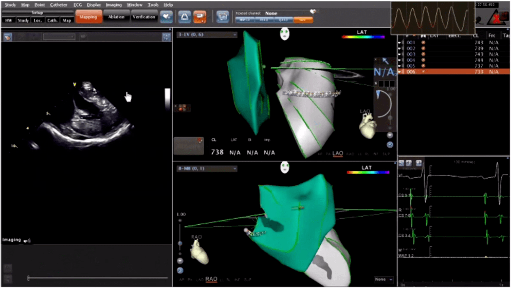 cscsf 2020 | 常栋:ice指导复杂pmva和hocm消融_导管