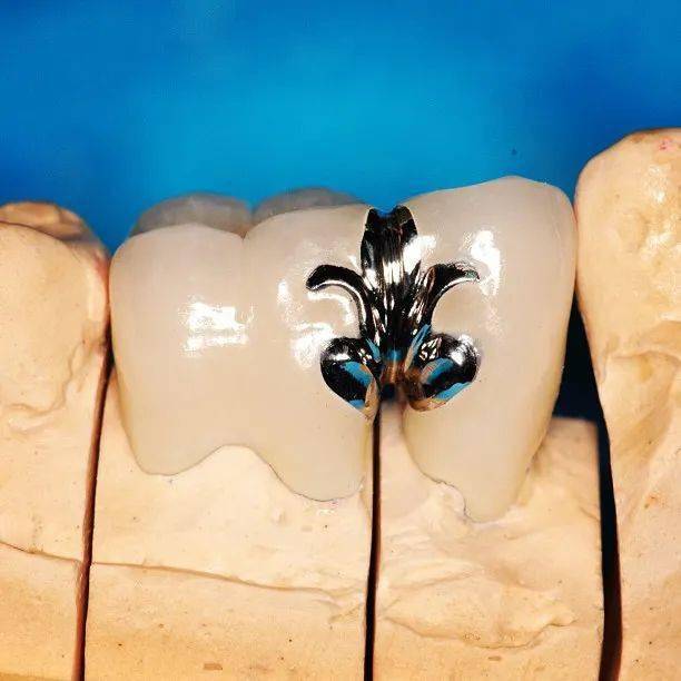 【艺术】牙齿上的装饰你不懂,爱我就送我满口大金牙