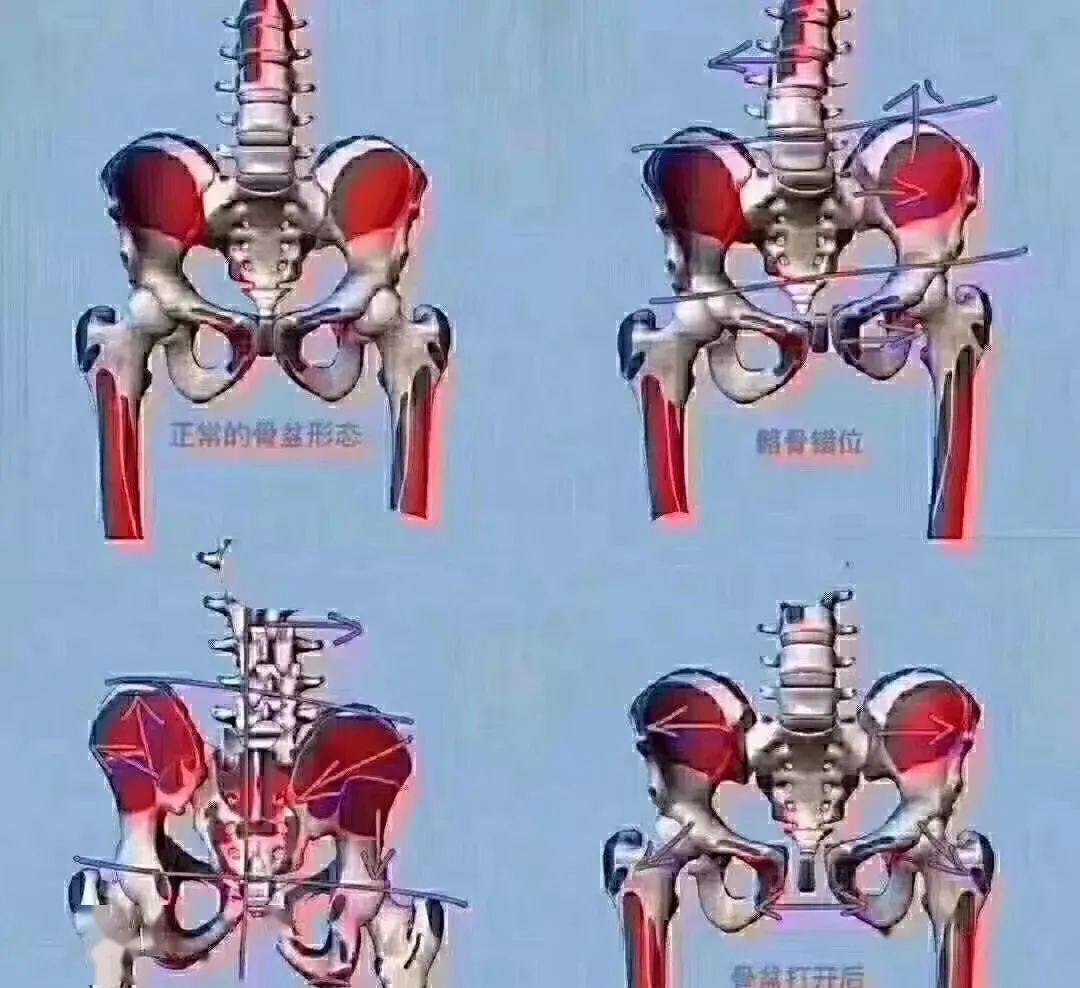 骨盆不修复,后果有多严重 你知道吗?