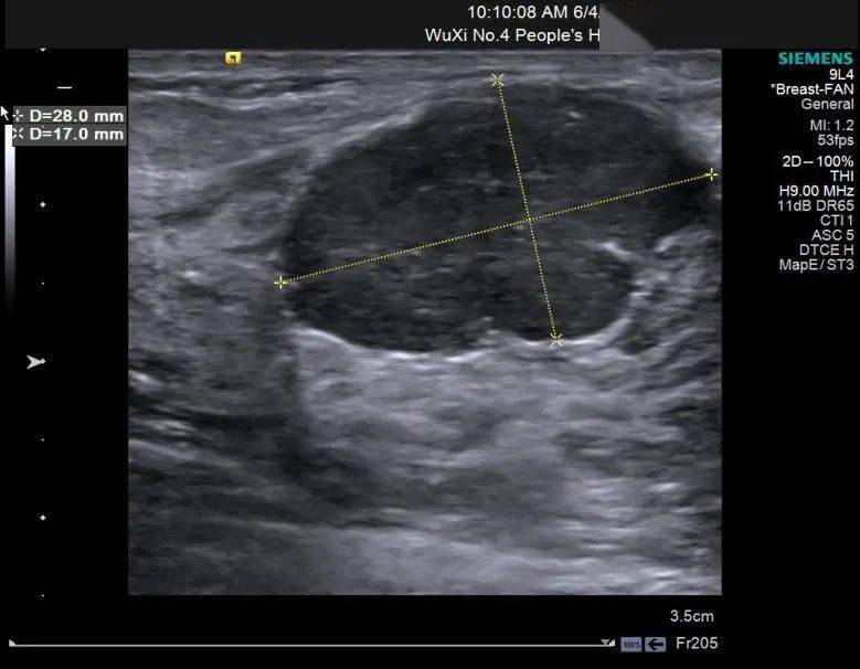 可能你见过一些乳腺管状腺瘤的超声表现但这些病例真的不一样