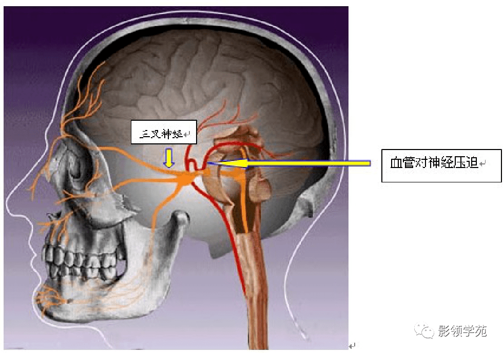 三叉神经解剖及常见疾病MR表现_脑神经