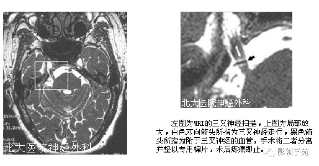 三叉神经mri影像解剖图图片