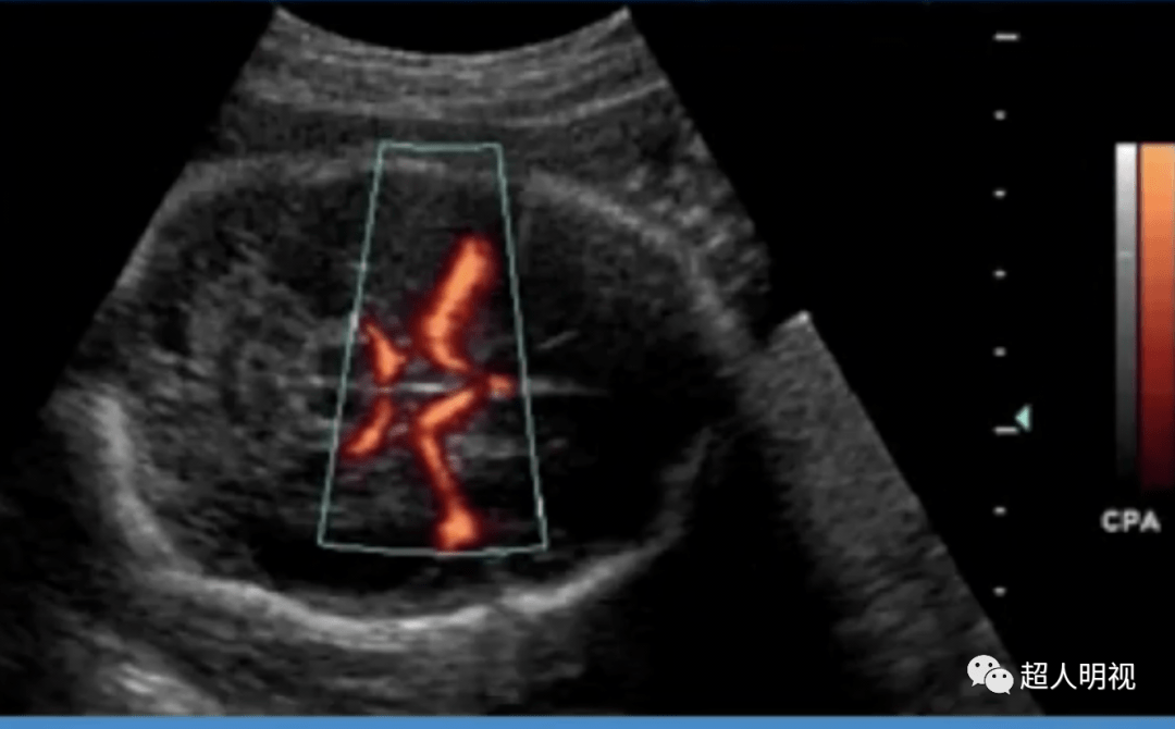 胎儿大脑中动脉sd图片