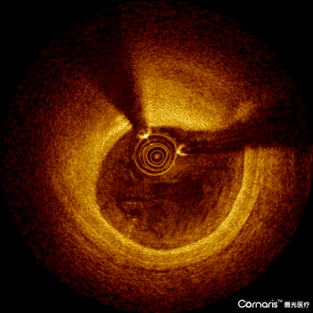 国货之光中科微光医疗oct首批试用特辑