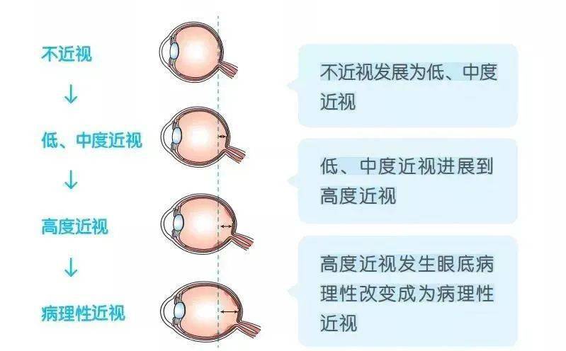 高度近视不是一天变成的,眼科专家告诉你高度近视形成的3个阶段