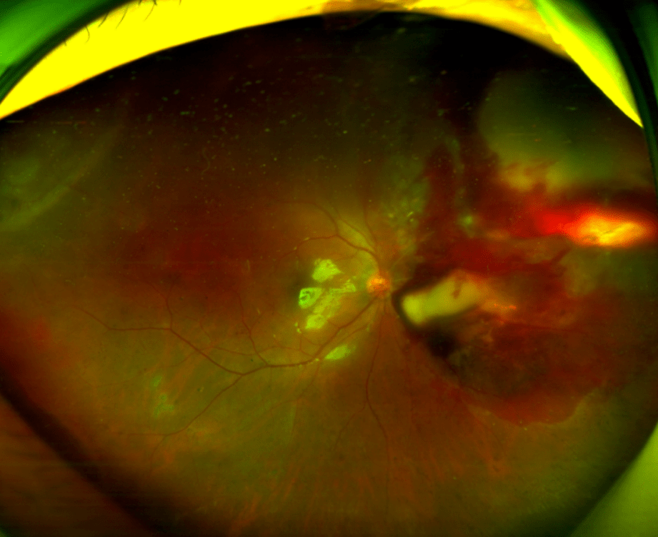 保视力,保眼球,提高生存率——汪朝阳教授谈脉络膜黑色素瘤治疗新进展