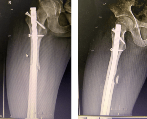 首届髓内钉病例大赛慈林医院骨科陈立军进全国前24