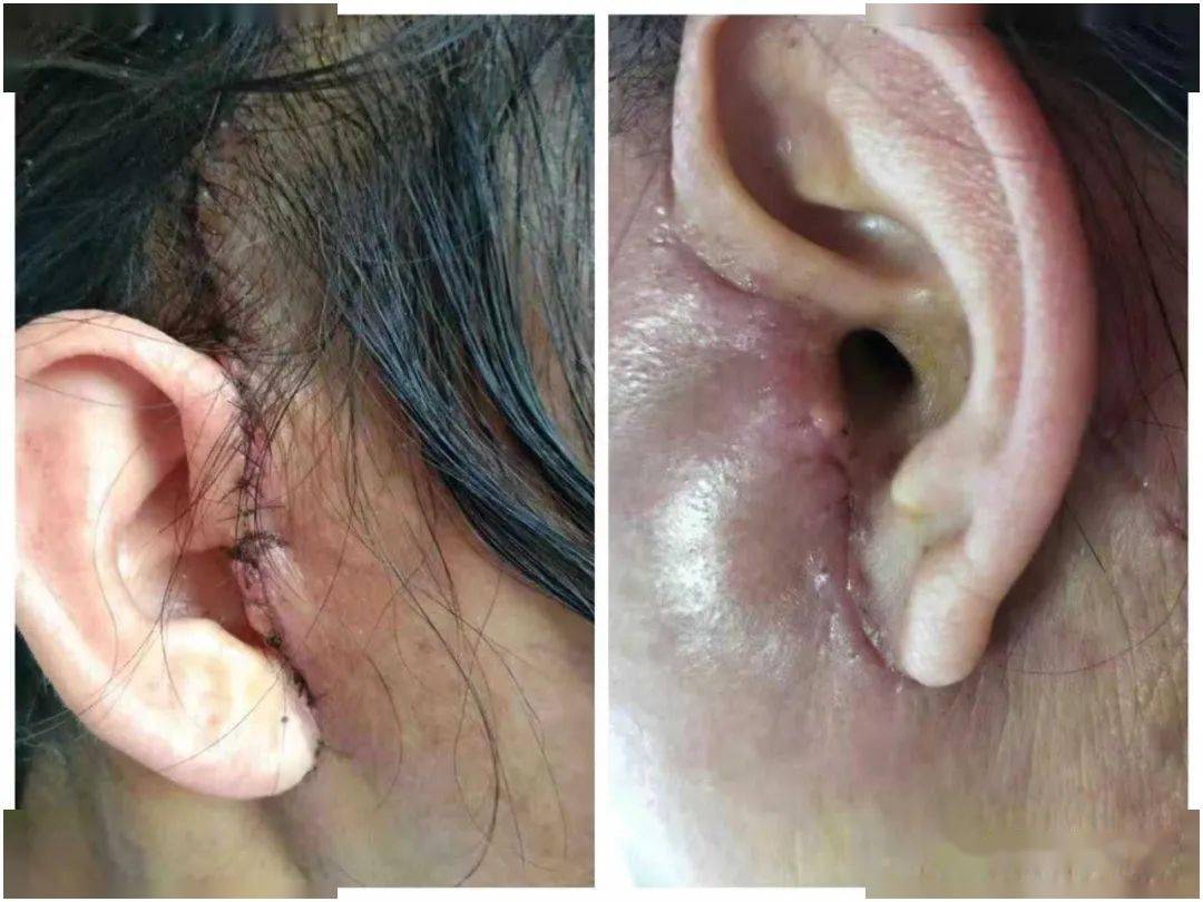 满脸冒钢丝线耳垂切没如此整容太吓人6868视频可能引起不适