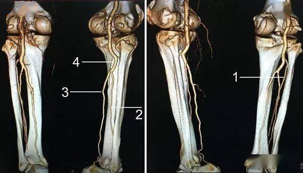 胫前动脉走行图片