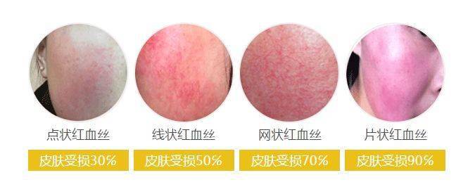 面部红血丝问题究竟出现在哪有哪些办法可以改善