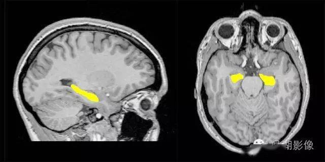 头颅ct海马区位置图片