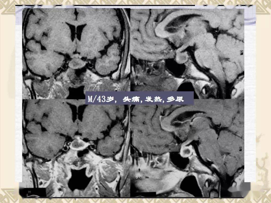 垂體病變的mri診斷