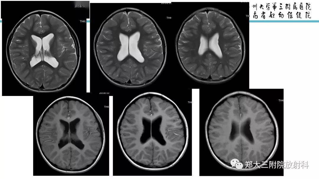 【每日一例1213】4岁男童,灰质异位的病例分析