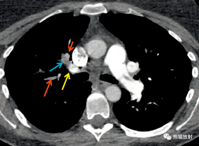 格艾选读丨急性肺动脉血栓栓塞症机理及影像表现