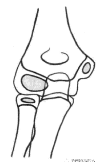 影像基础肱骨内上髁骨折分期