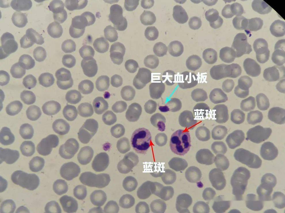 一例may-hegglin异常病例分享_血小板