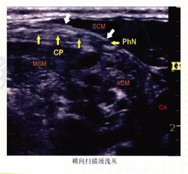 超聲引導下頸叢神經阻滯超聲系列課