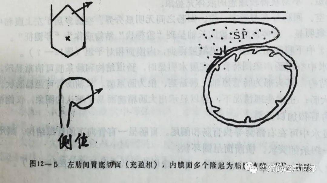 探頭自左肋弓下沿充盈胃腔從胃休向胃竇滑行掃查,瞭解胃的體表投影.