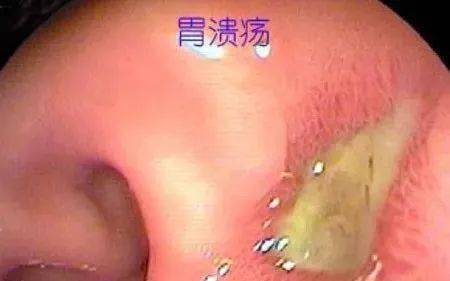 胃溃疡与早期胃癌症状傻傻分不清如何鉴别