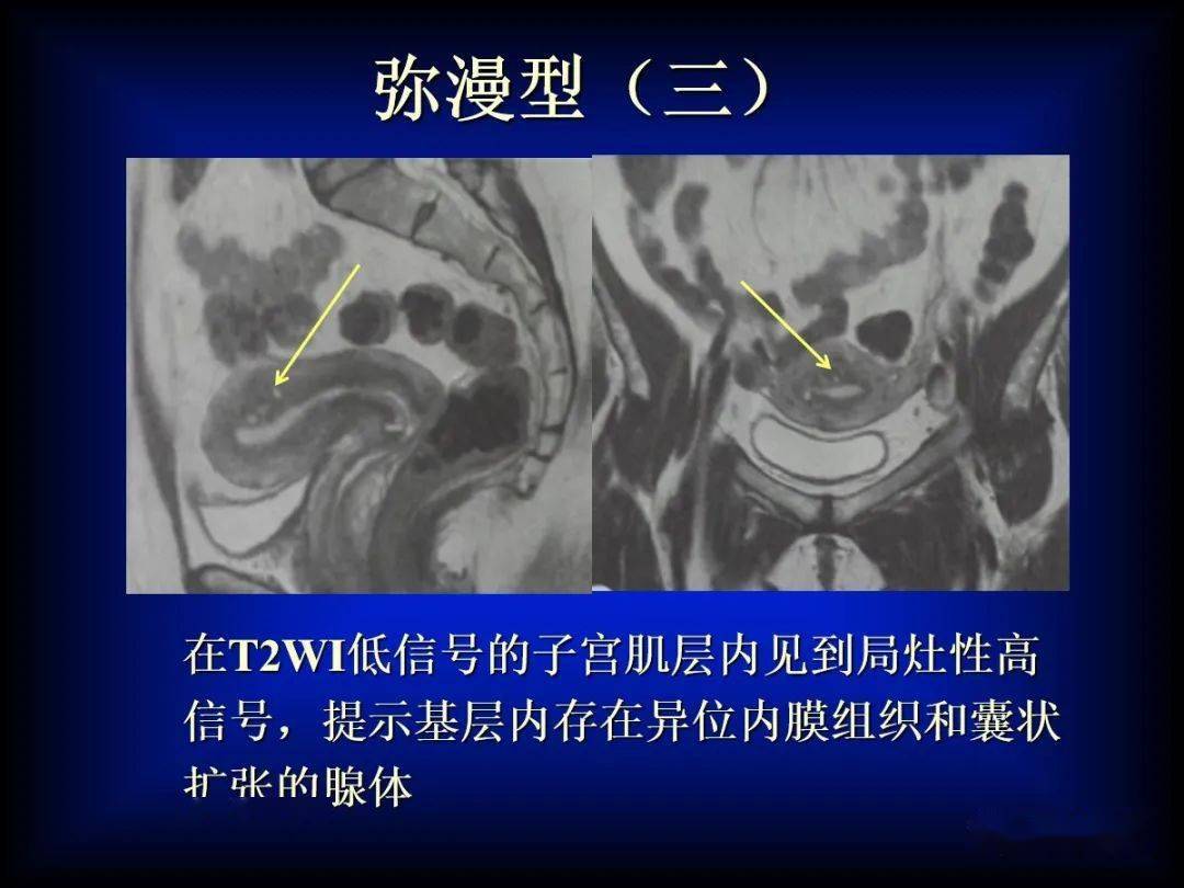子宫腺肌症的MRI表现_内膜