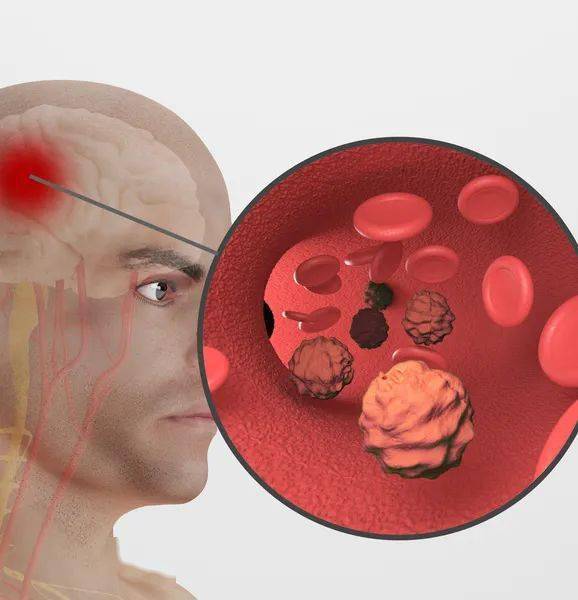 21岁大学生通宵打游戏脑袋差点爆炸冬季预防脑血管病一定要牢记这几点