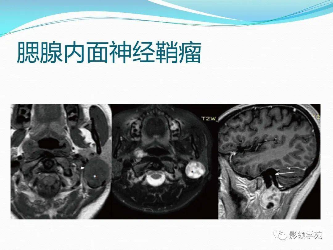 面神经管 断层图片