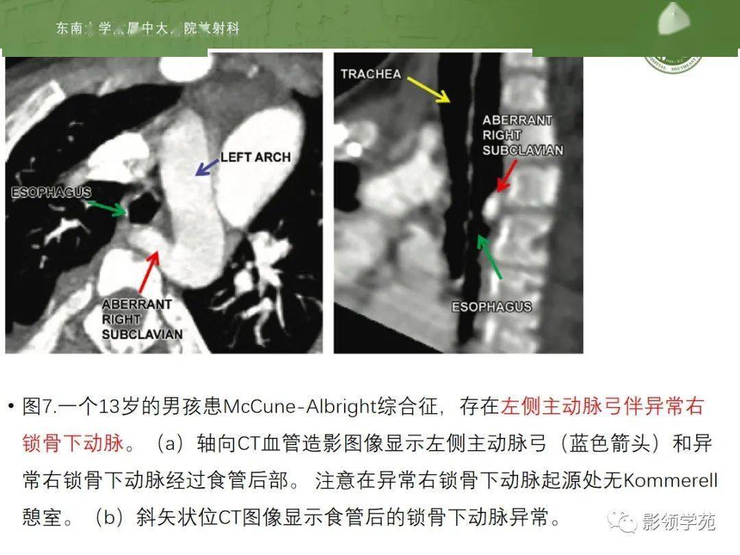 主动脉弓磁共振图像图片