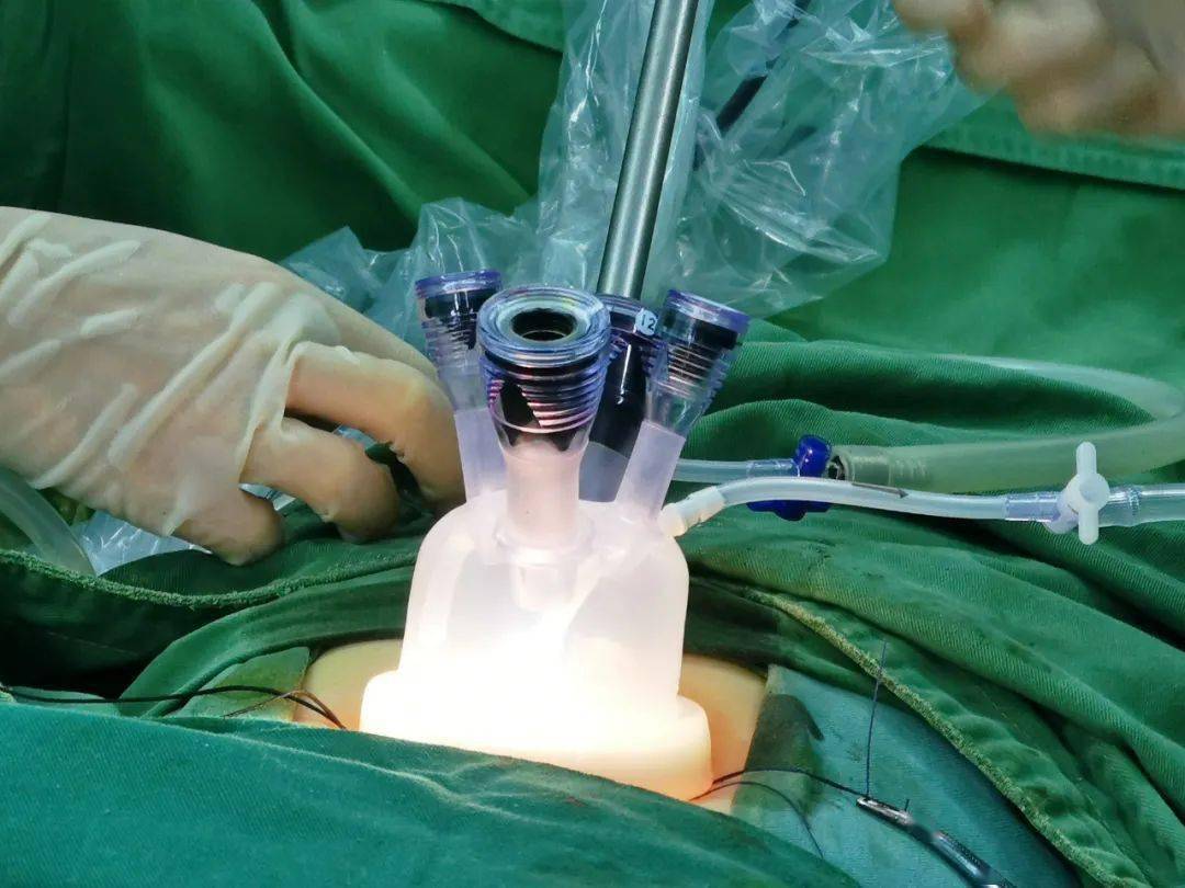 腹腔镜手术图片 打孔图片