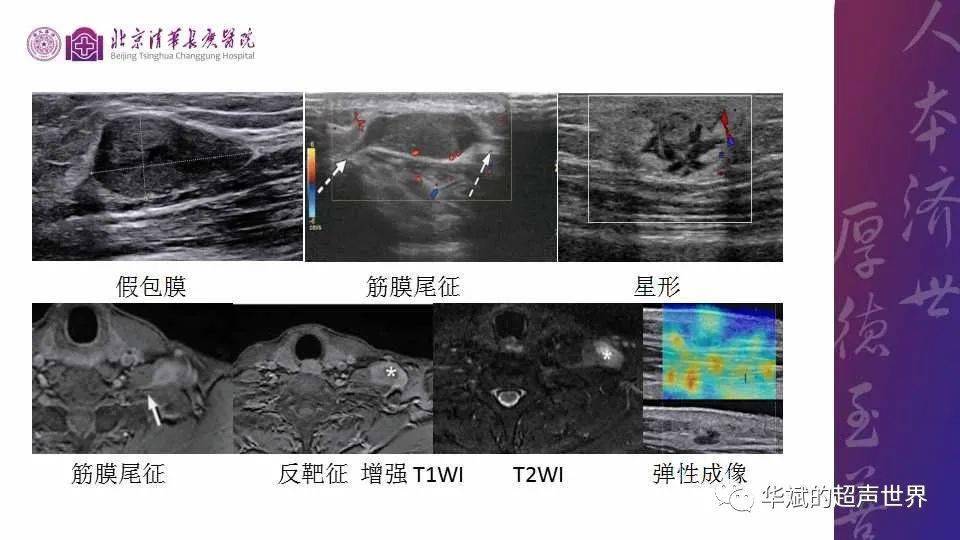 病例和文献复习结节性筋膜炎