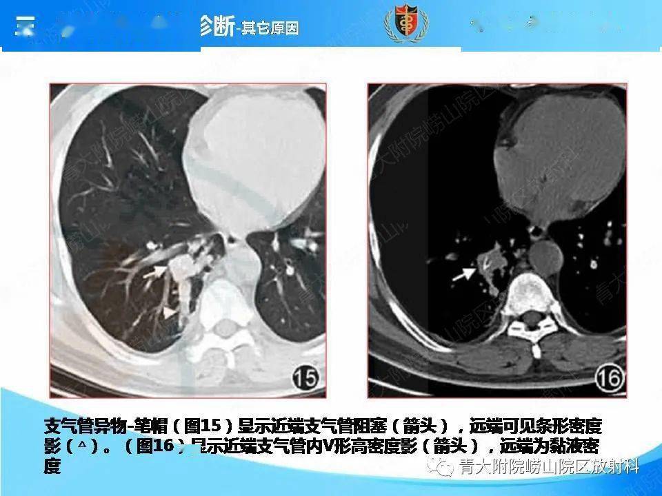 支气管粘液栓图片