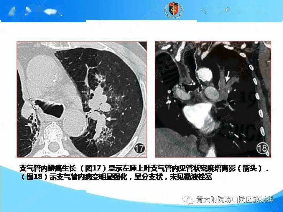 支气管粘液栓图片