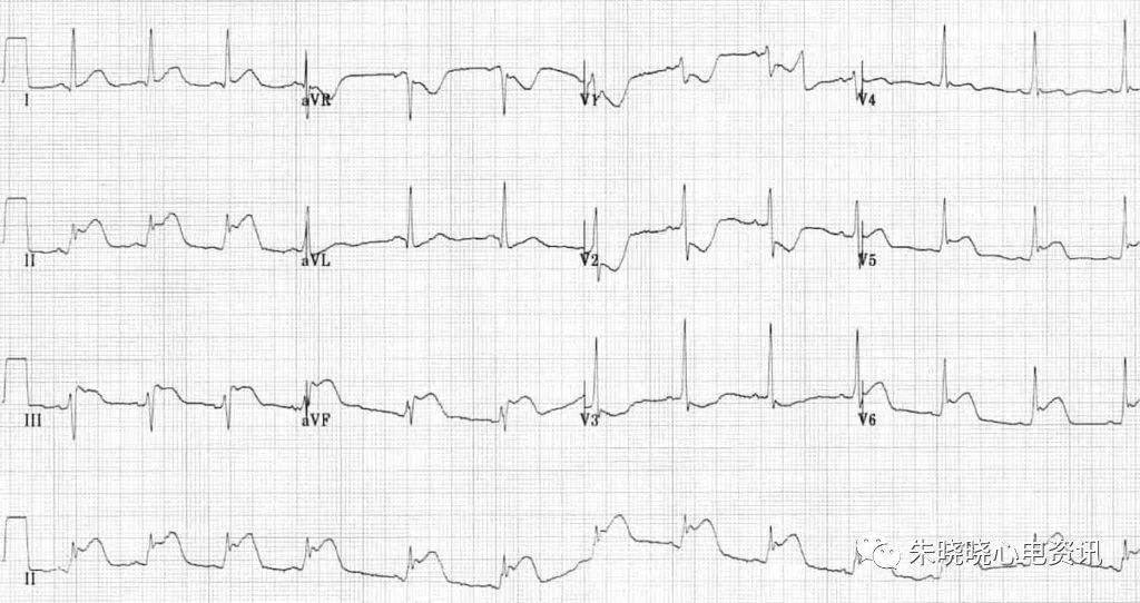 冠心病心电图心肌缺血图片
