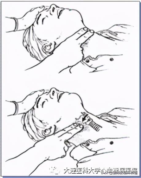 触摸颈动脉位置图片
