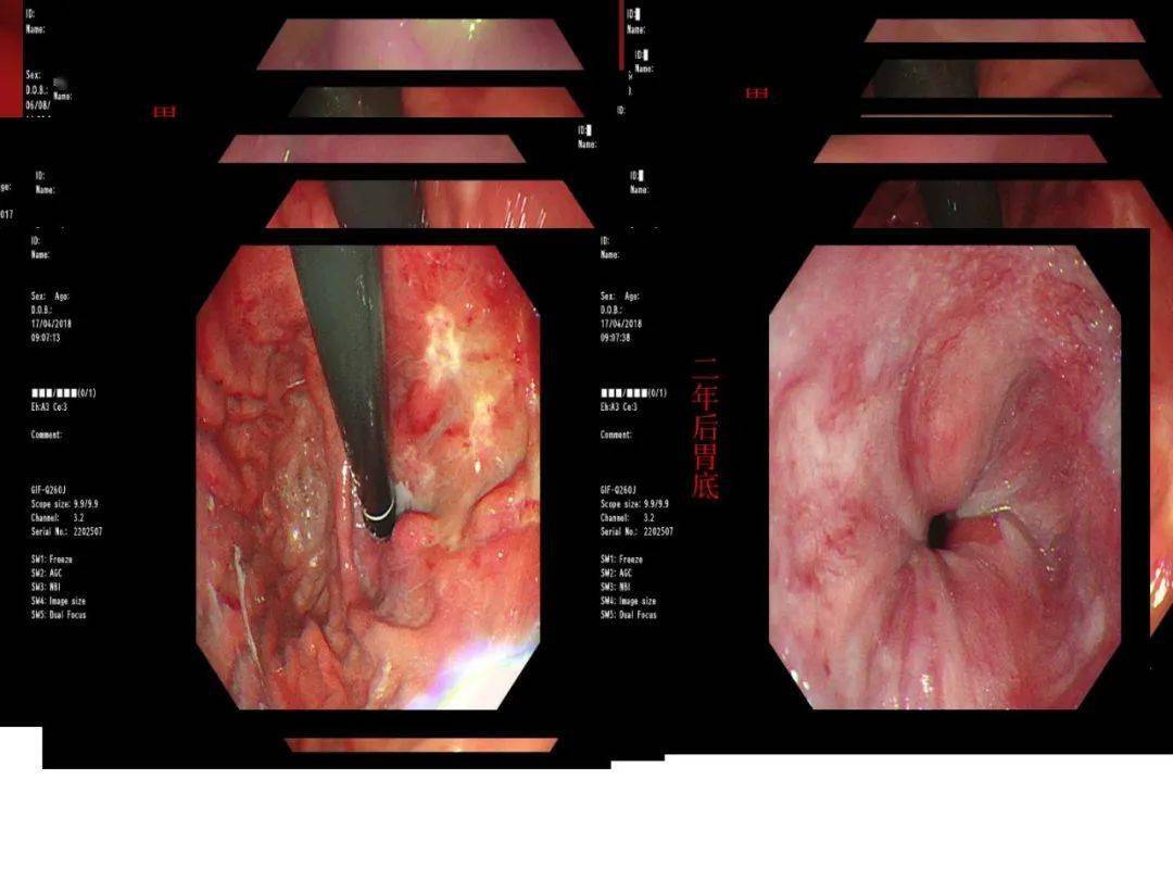 食管胃底静脉曲张症状图片