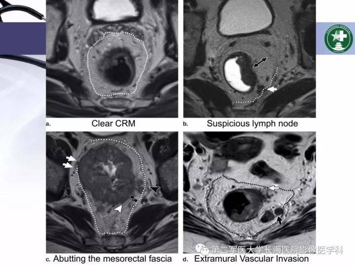 直肠癌mri评价及影像学结构化规范报告