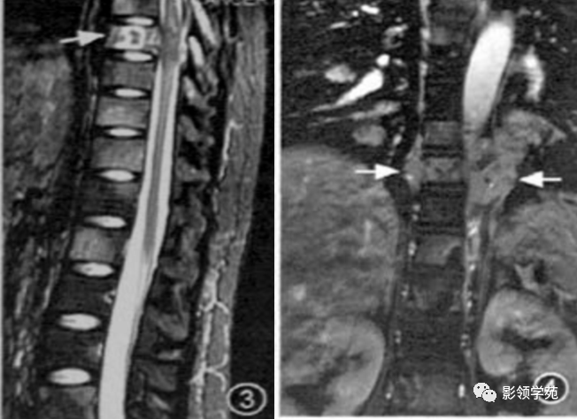 布氏杆菌性脊柱炎影像学表现