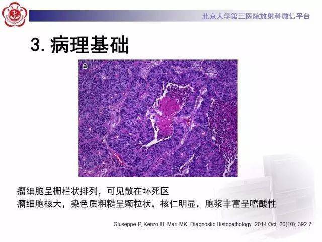 呼吸系統丨肺大細胞神經內分泌癌影像表現