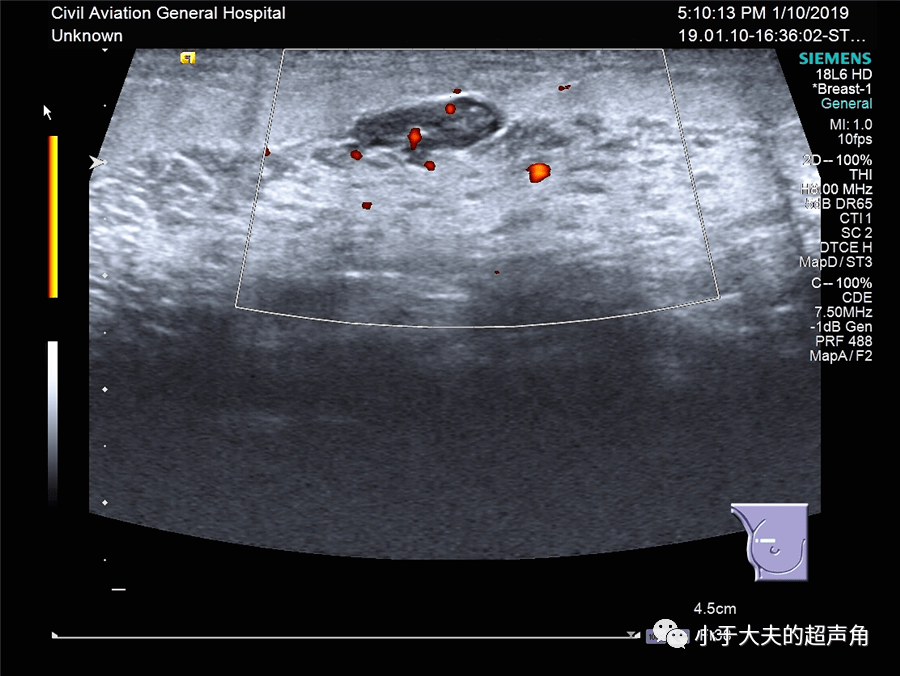 圖4:同側腋下副乳內擴張的乳導管.