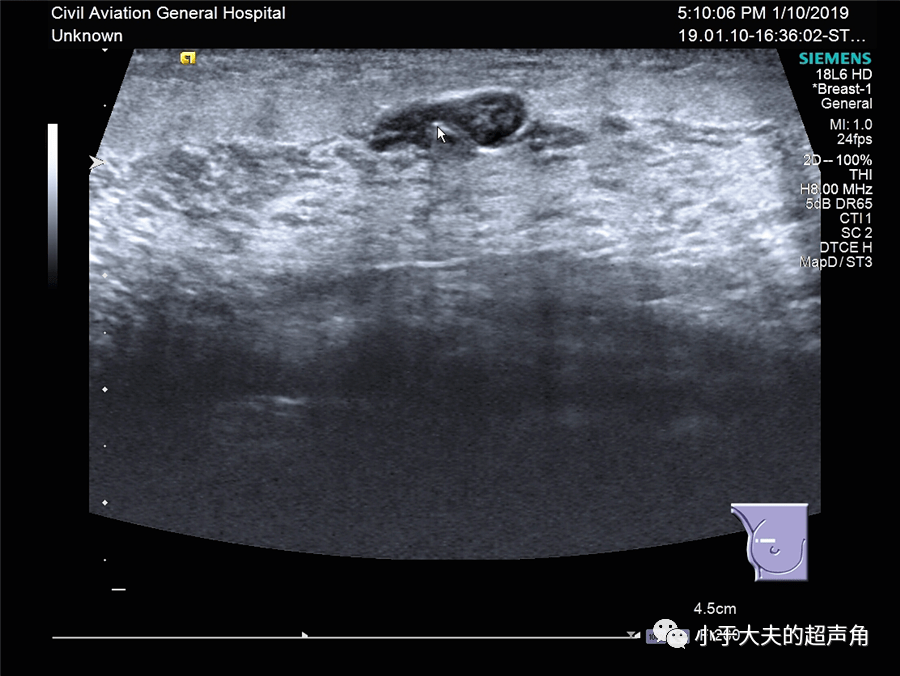 超聲隨響第42期乳腺複雜性旺熾性腺病