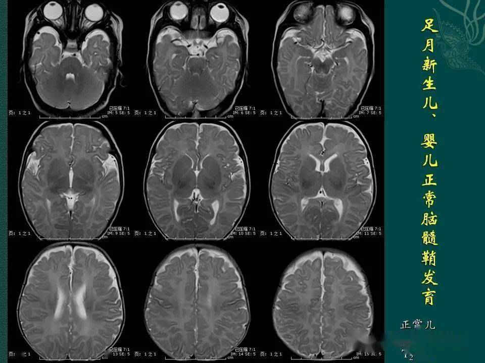 足月儿及婴儿神经系统发育mri