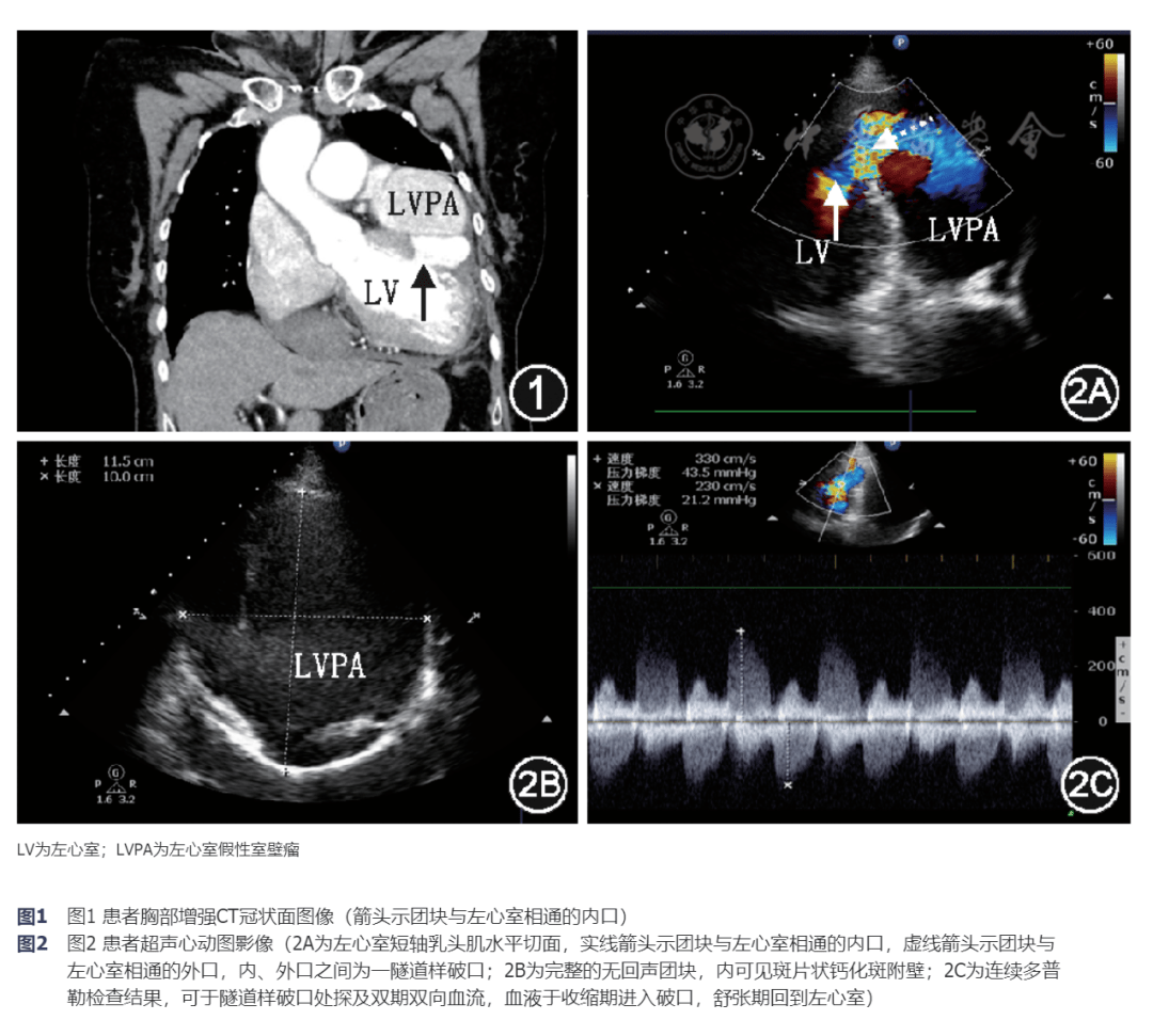 左心室假性室壁瘤(left ventricular pseudoaneurysm,lvpa)的诊断基本